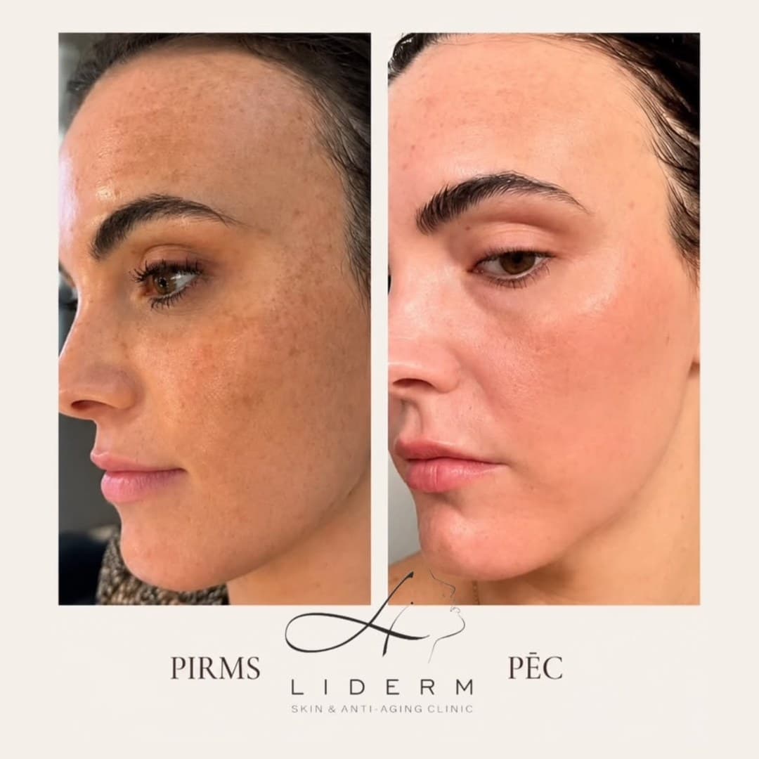 Результат — до и после в клинике LIDERM