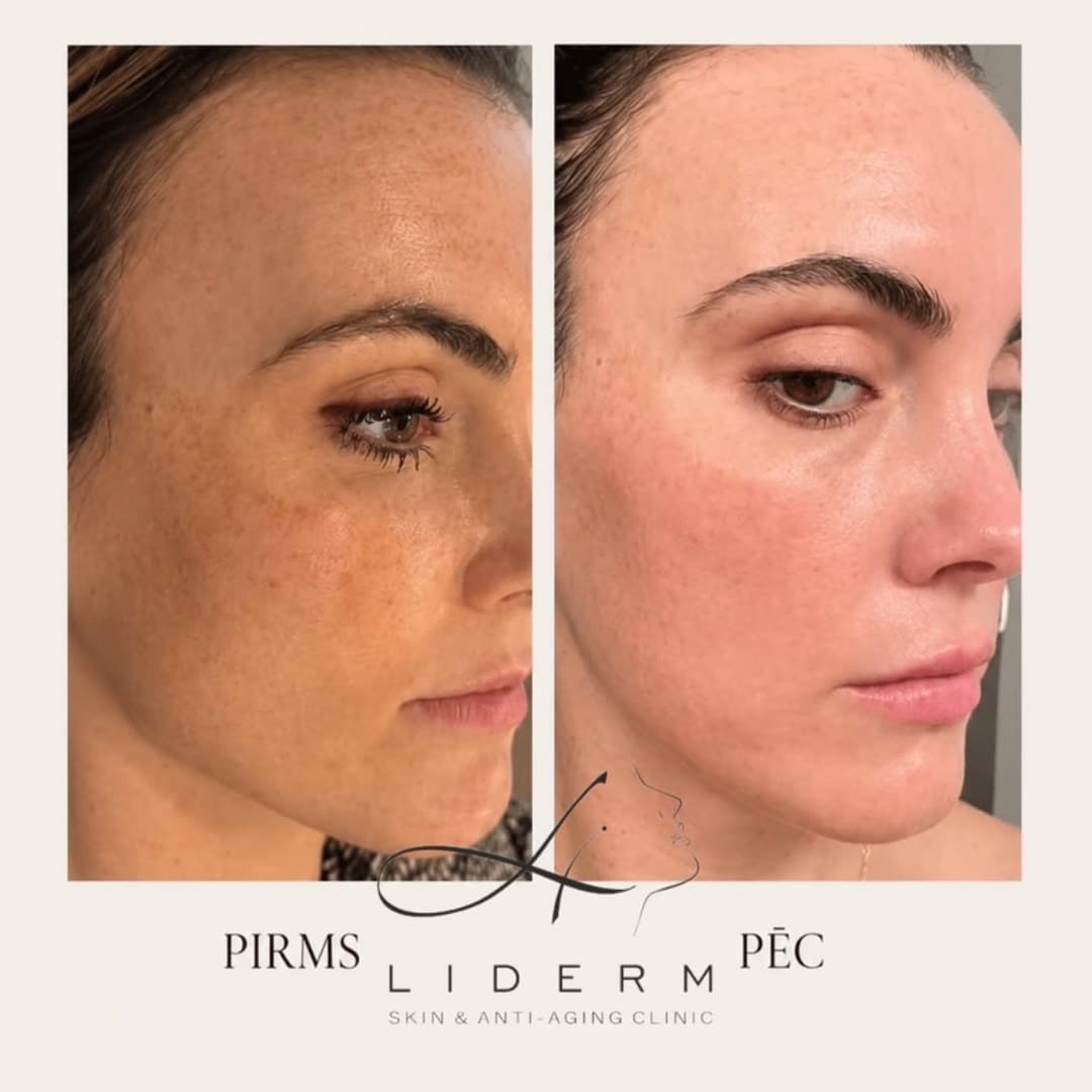 Результат — до и после в клинике LIDERM