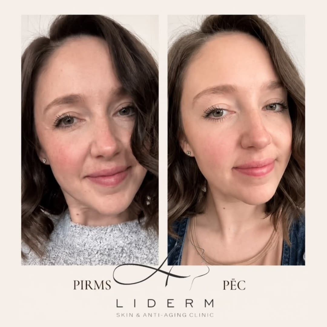 Результат — до и после в клинике LIDERM