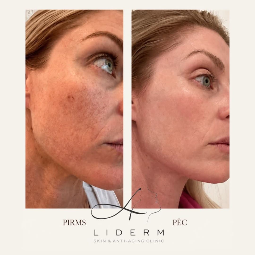 Результат — до и после в клинике LIDERM