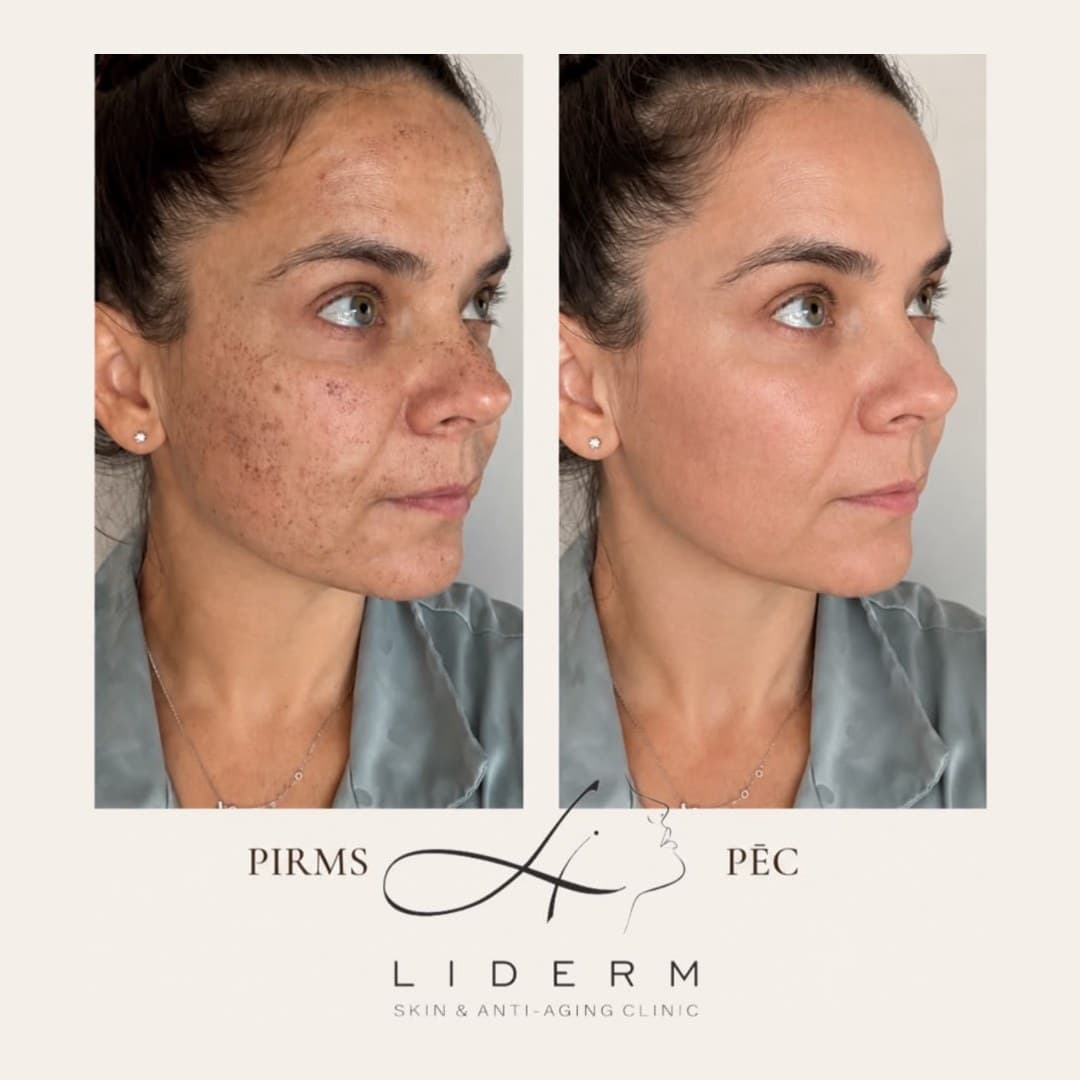 Результат — до и после в клинике LIDERM