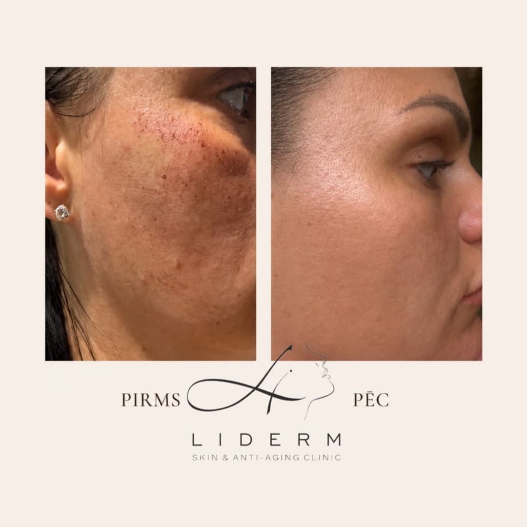 Результат — до и после в клинике LIDERM