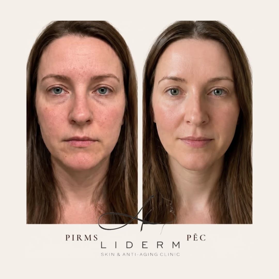 Результат — до и после в клинике LIDERM