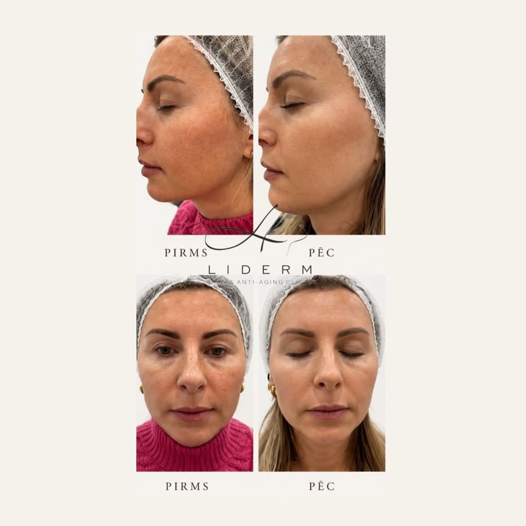 Результат — до и после в клинике LIDERM