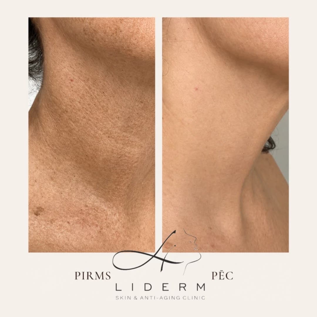 Результат — до и после в клинике LIDERM