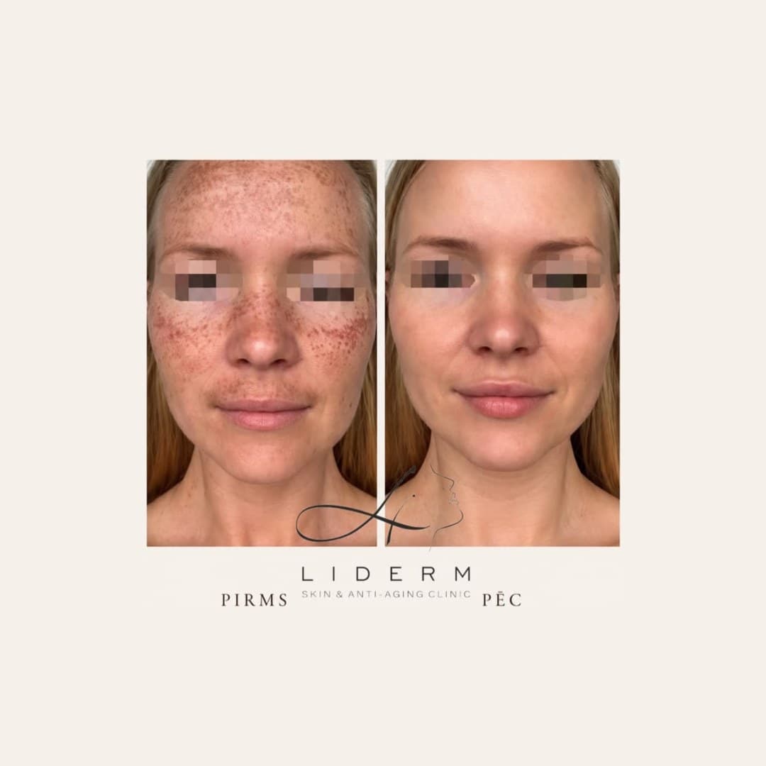 Результат — до и после в клинике LIDERM