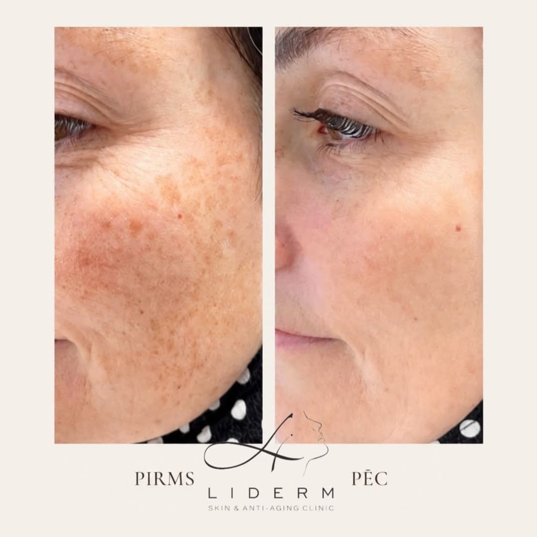 Результат — до и после в клинике LIDERM