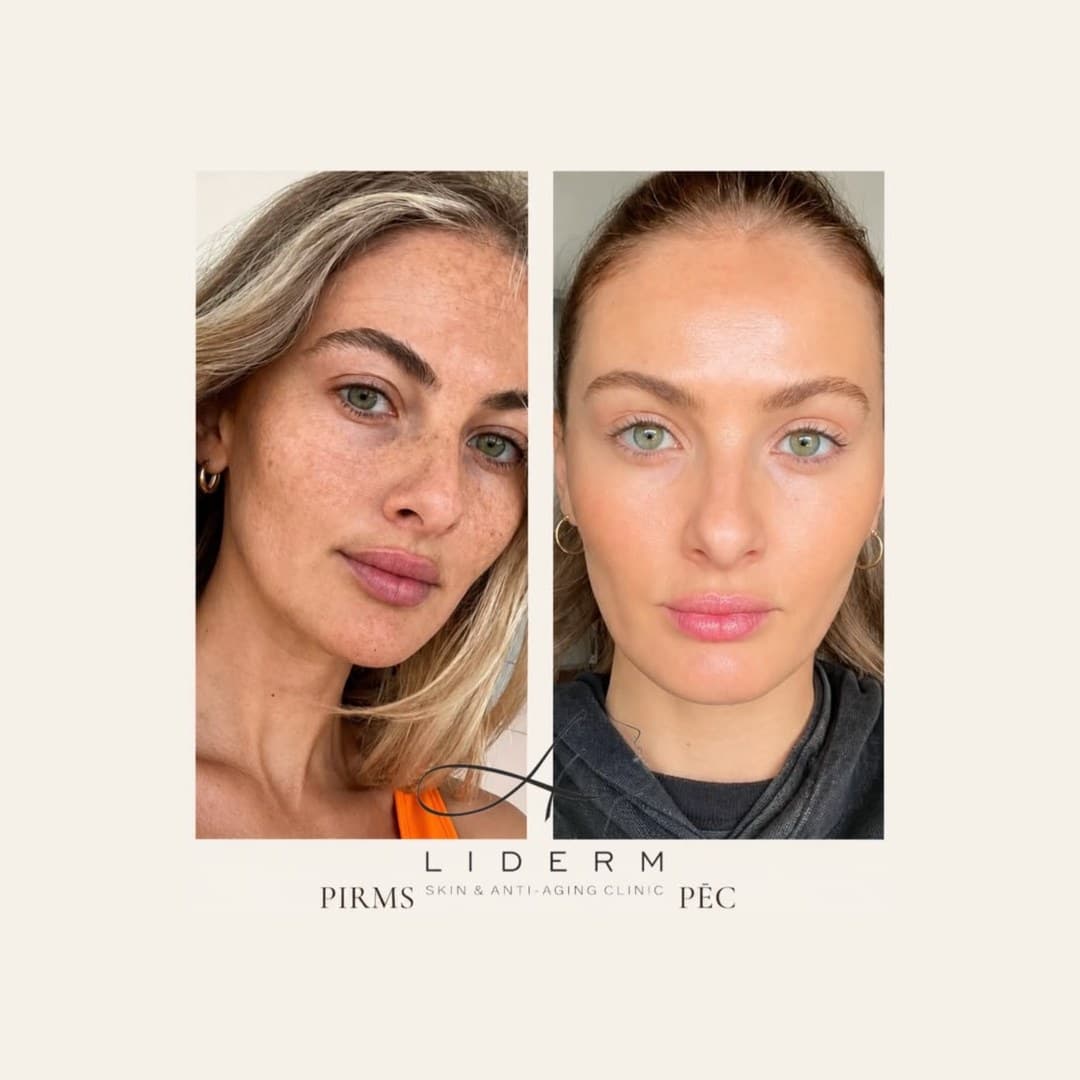Результат — до и после в клинике LIDERM