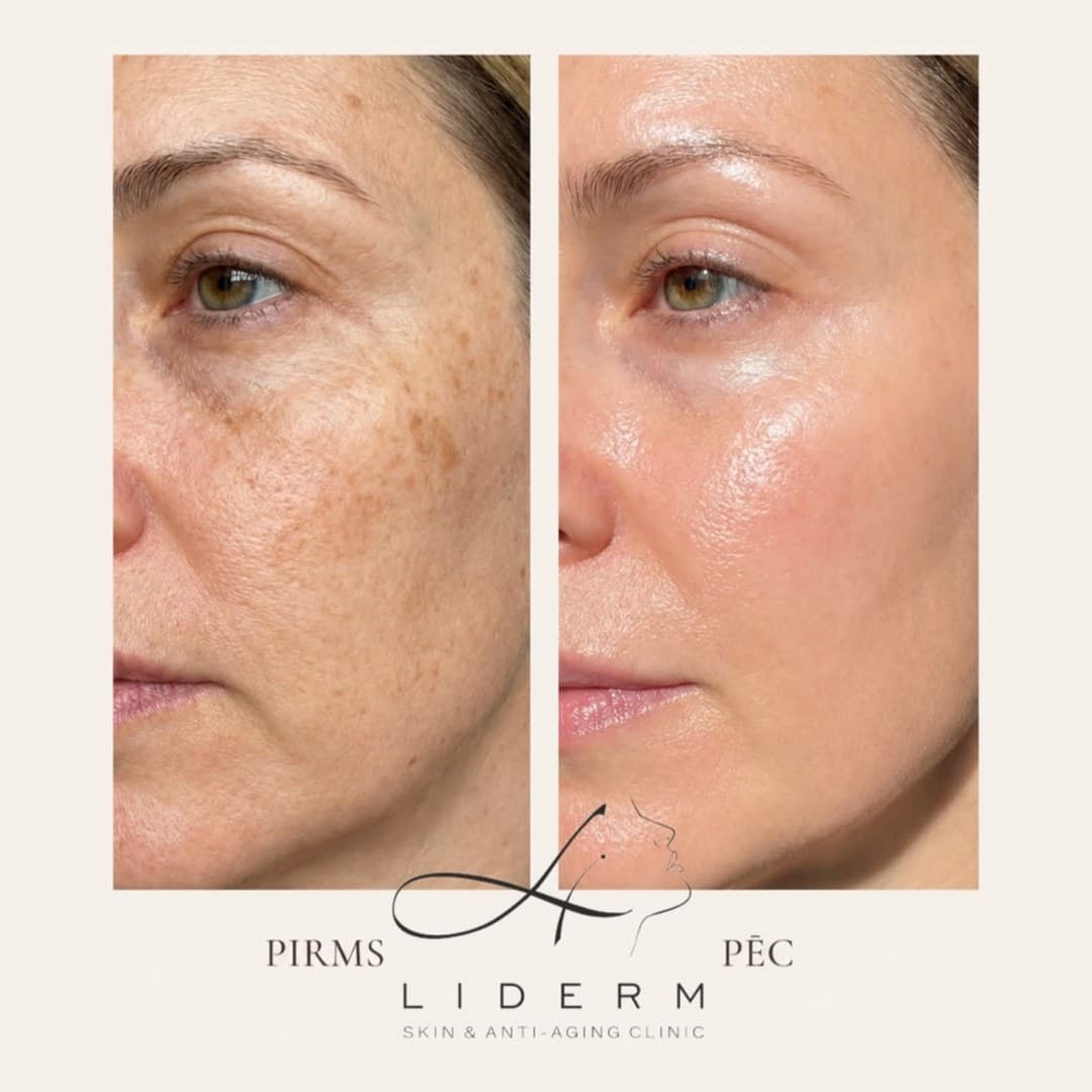 Результат — до и после в клинике LIDERM