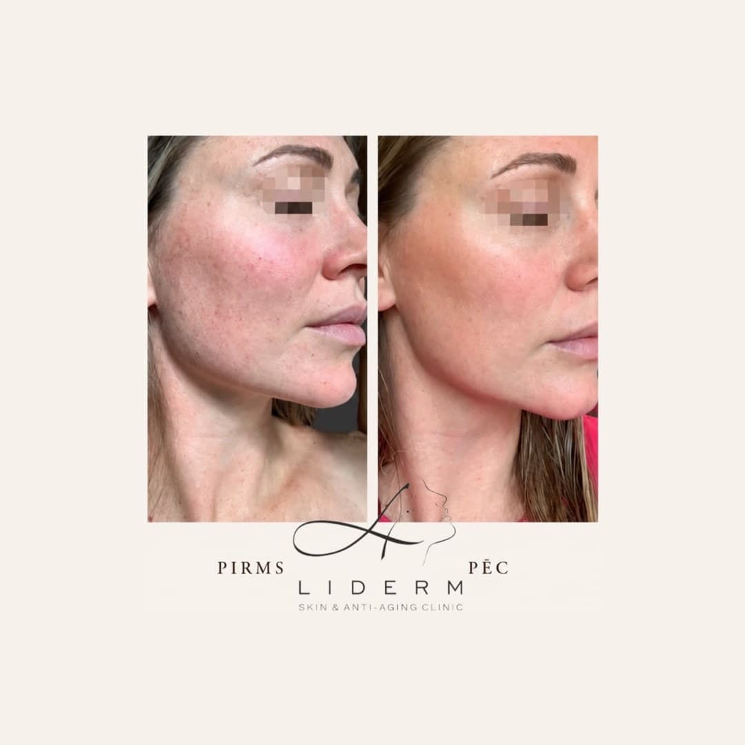 Результат — до и после в клинике LIDERM