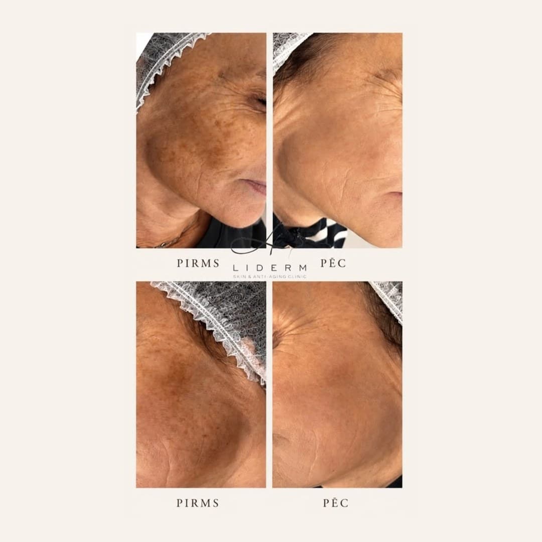 Результат — до и после в клинике LIDERM