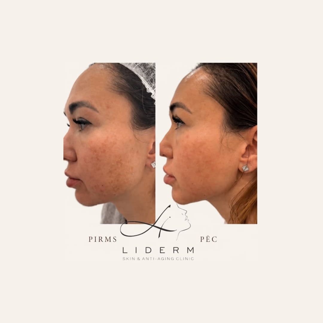 Результат — до и после в клинике LIDERM