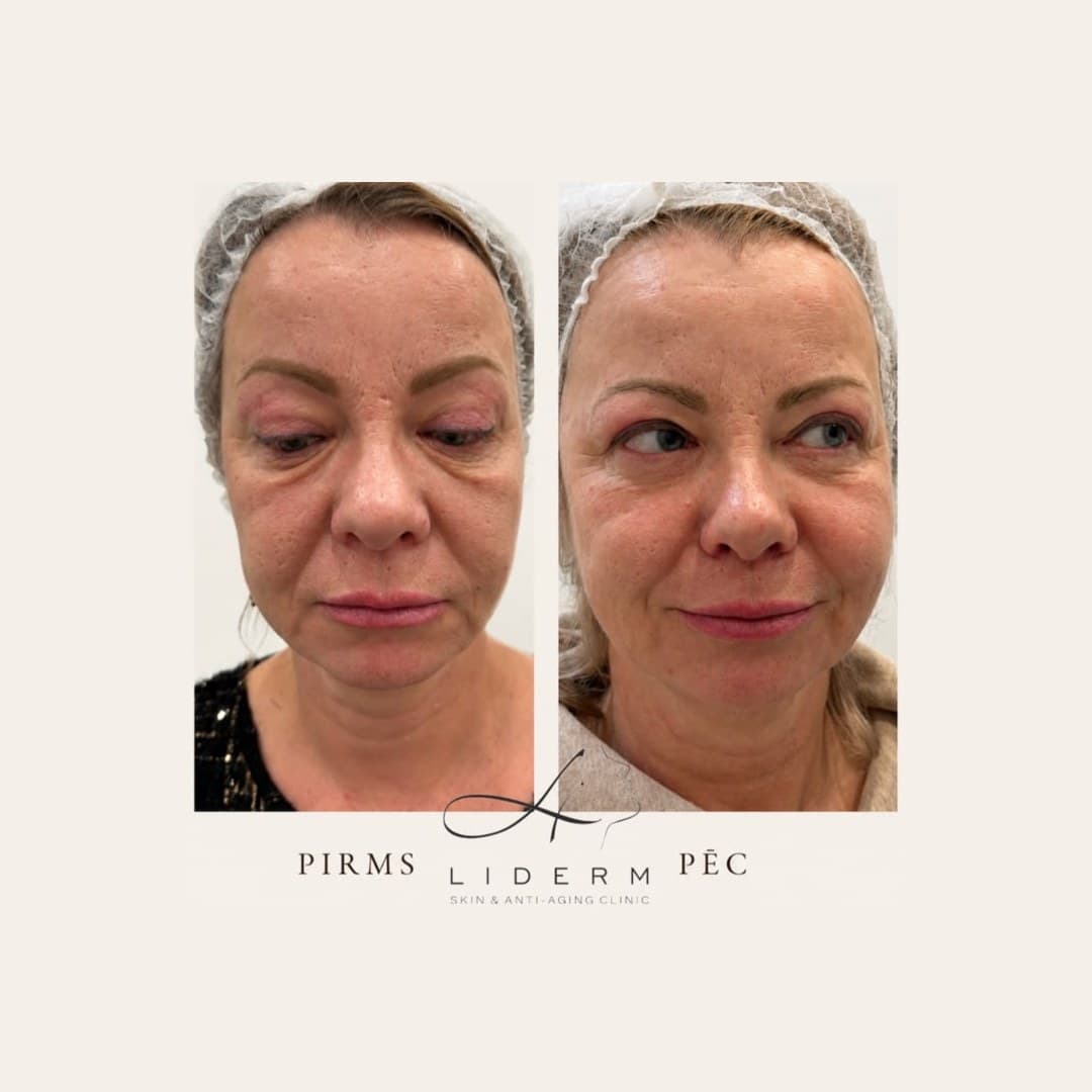Результат — до и после в клинике LIDERM