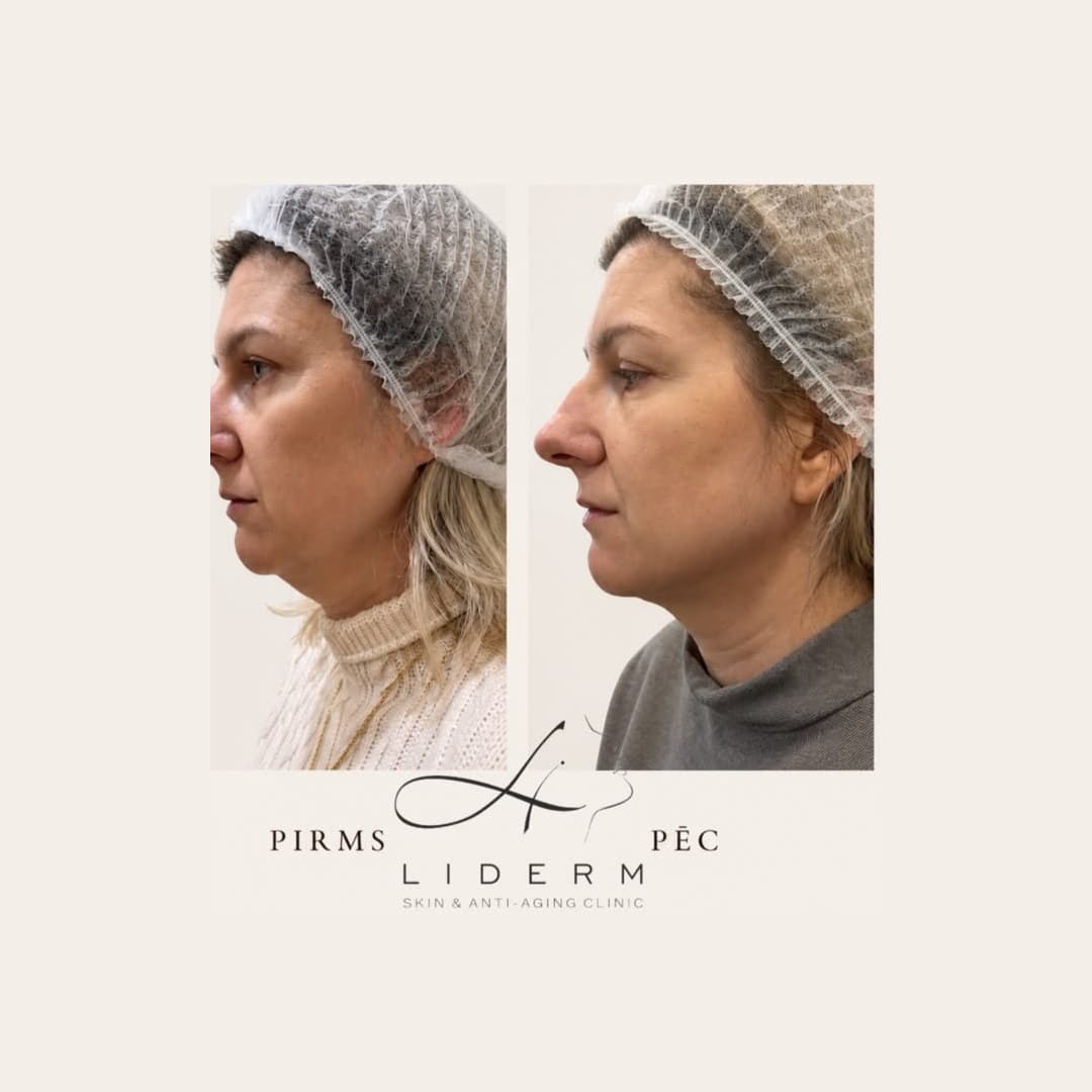 Результат — до и после в клинике LIDERM