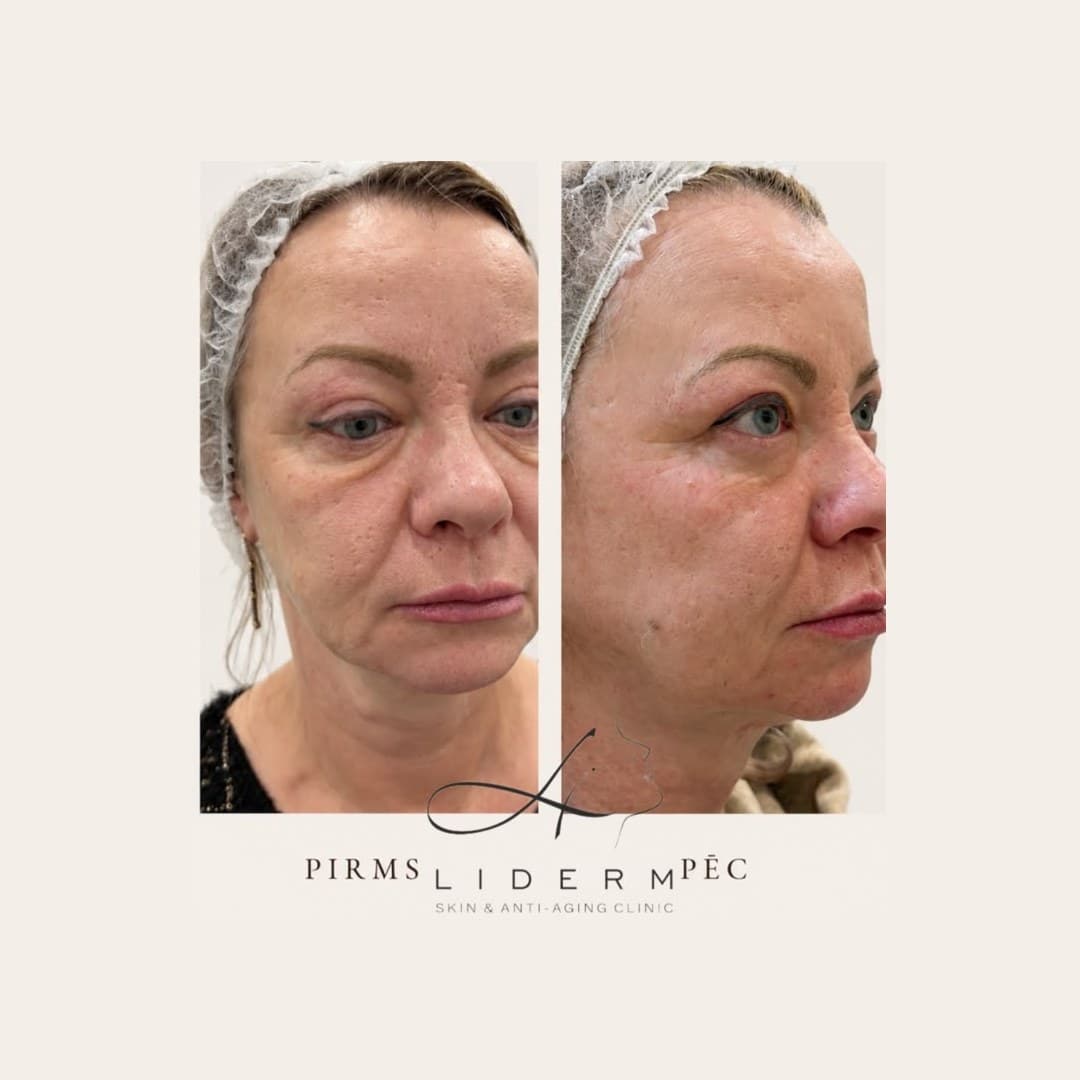 Результат — до и после в клинике LIDERM