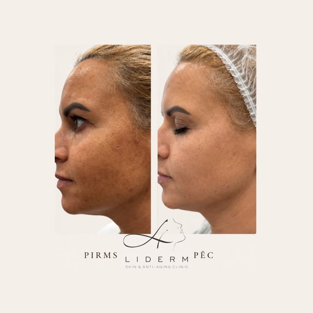 Результат — до и после в клинике LIDERM