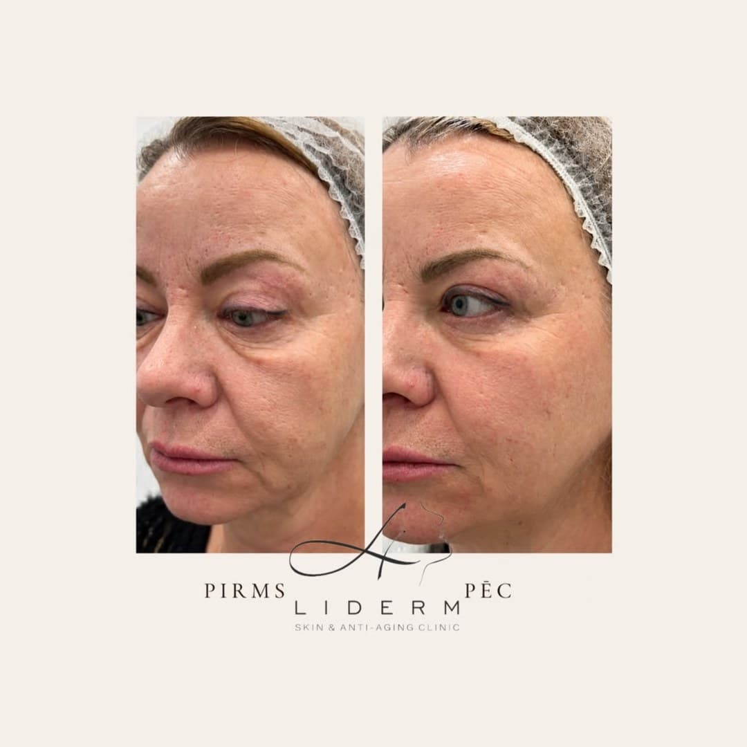 Результат — до и после в клинике LIDERM