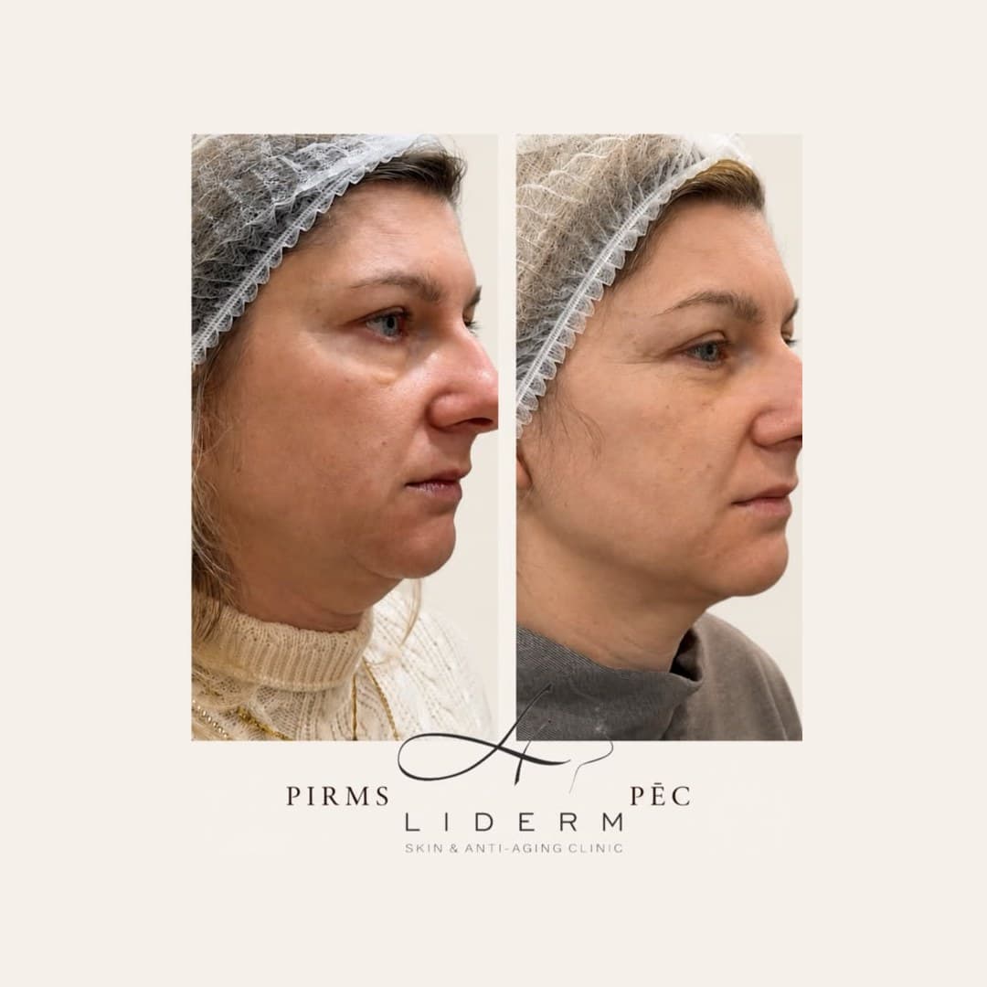 Результат — до и после в клинике LIDERM
