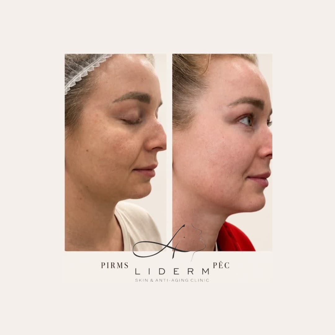Результат — до и после в клинике LIDERM