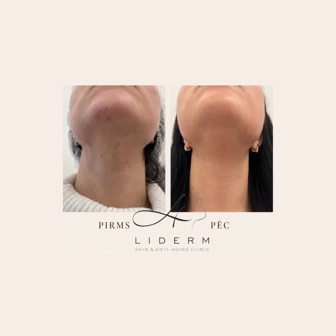 Результат — до и после в клинике LIDERM