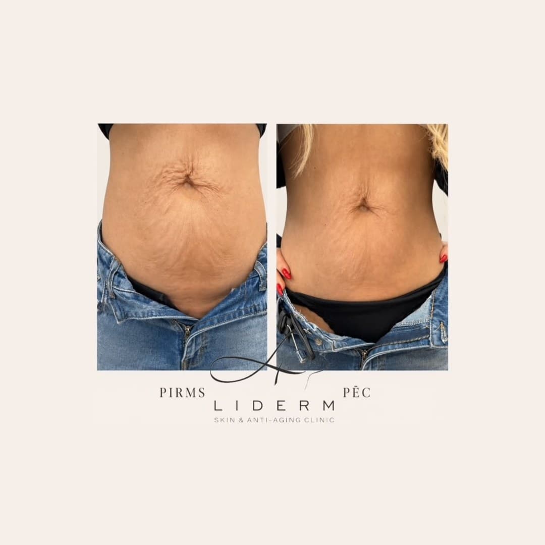 Результат — до и после в клинике LIDERM