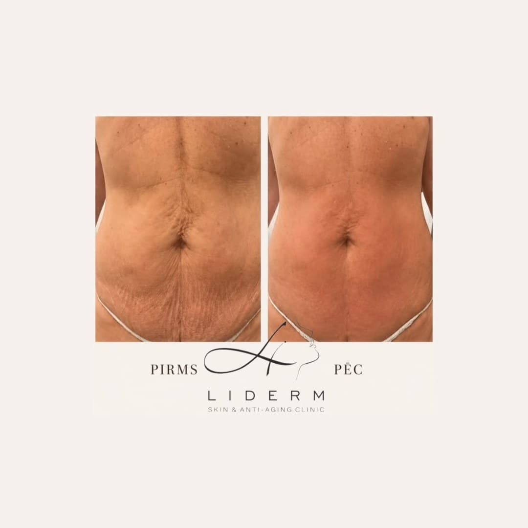 Результат — до и после в клинике LIDERM
