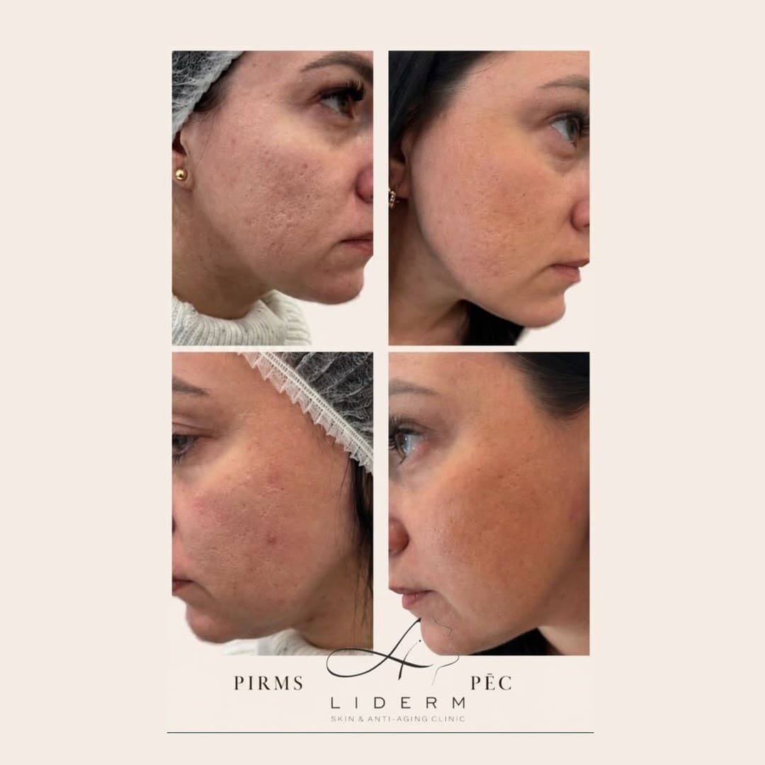 Результат — до и после в клинике LIDERM