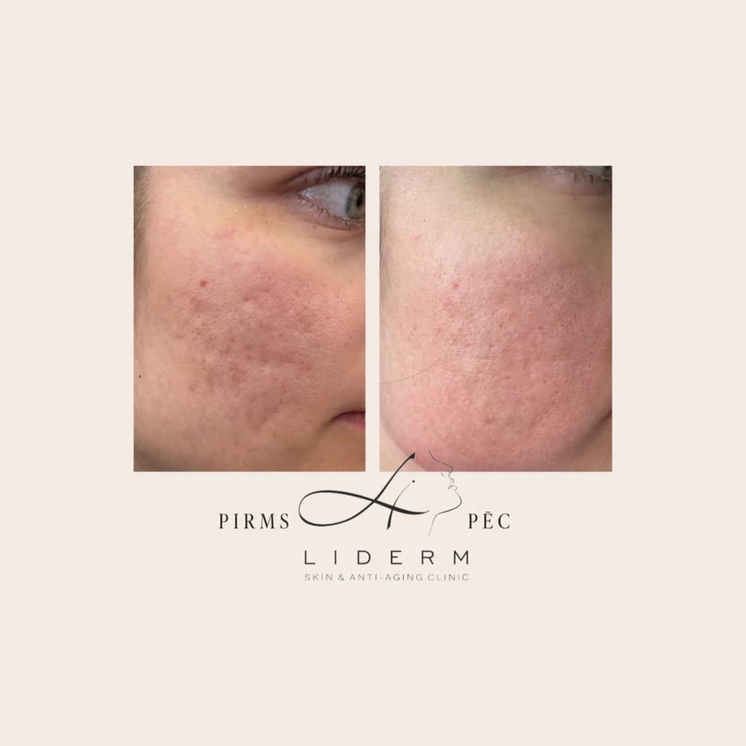 Результат — до и после в клинике LIDERM