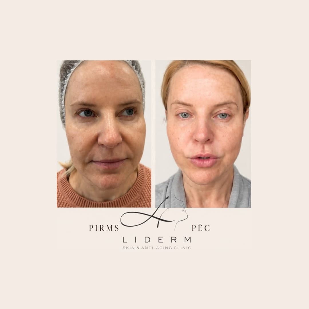 Результат — до и после в клинике LIDERM