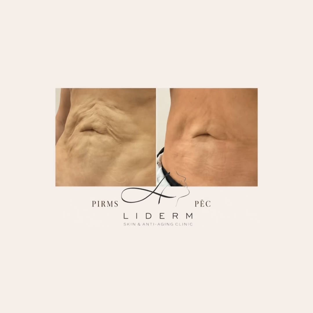 Результат — до и после в клинике LIDERM
