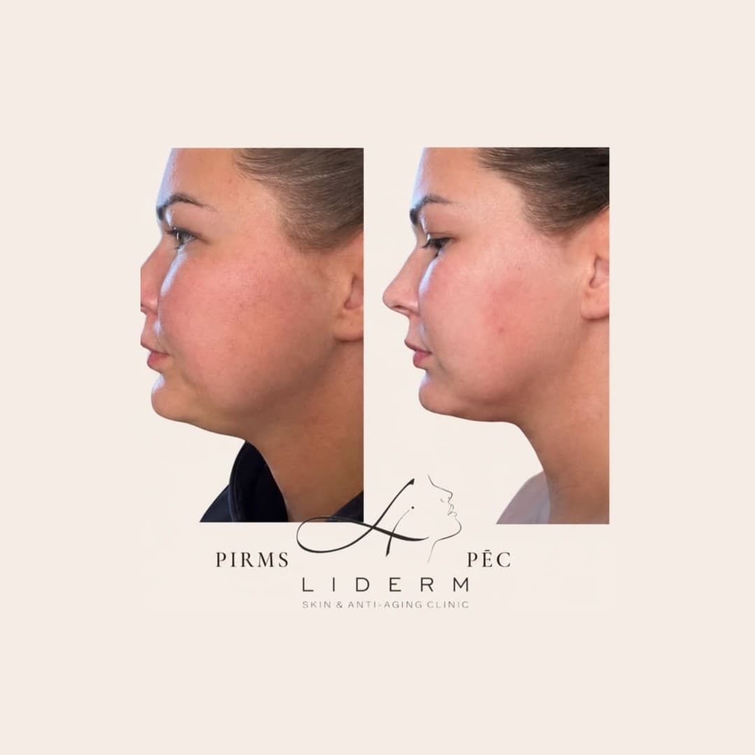 Результат — до и после в клинике LIDERM
