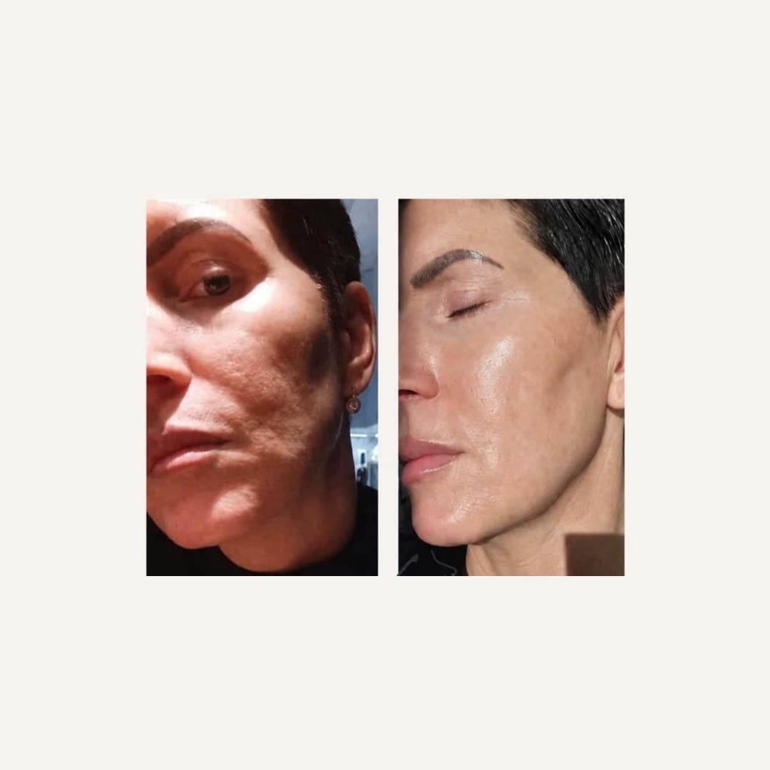 Результат — до и после в клинике LIDERM