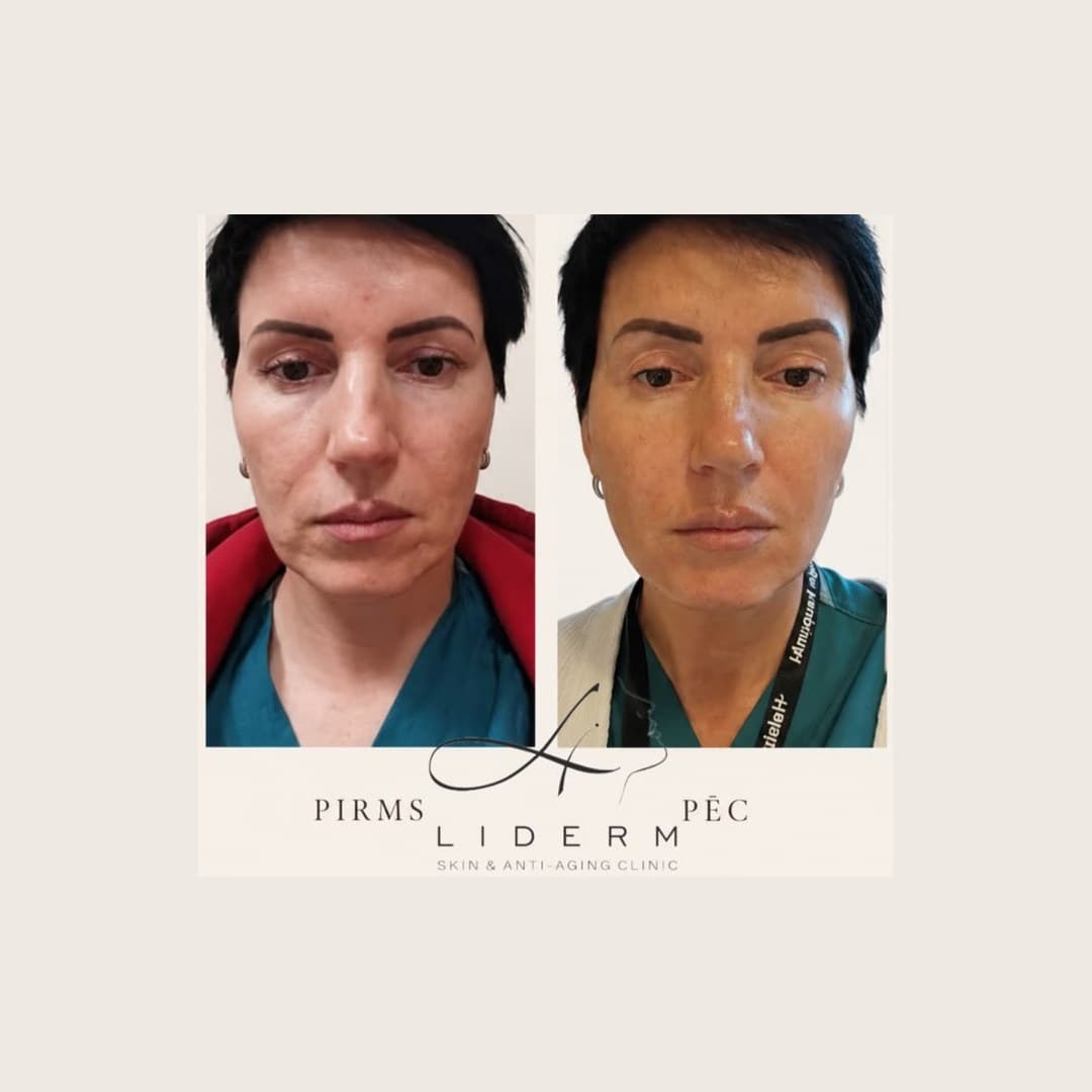 Результат — до и после в клинике LIDERM