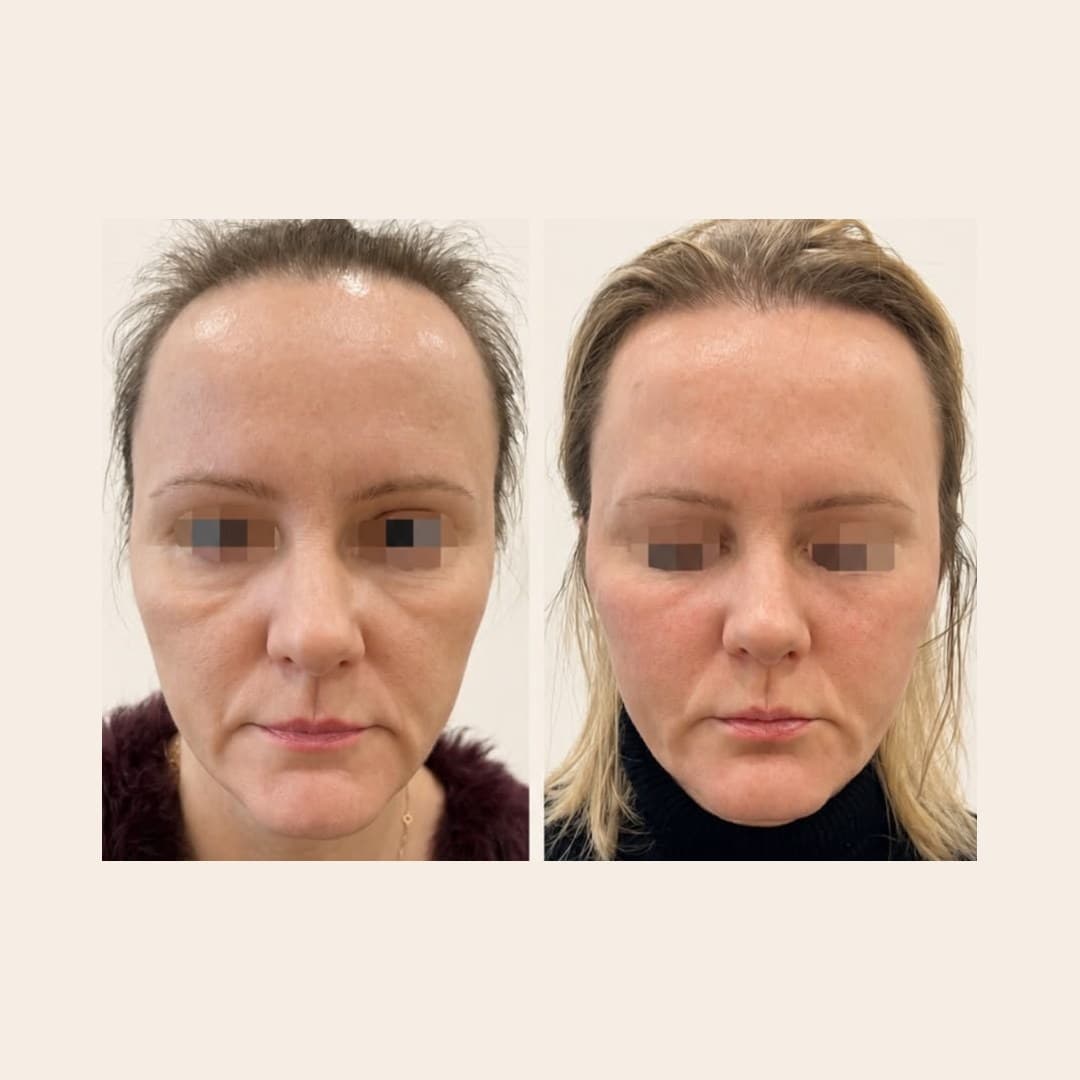 Результат — до и после в клинике LIDERM