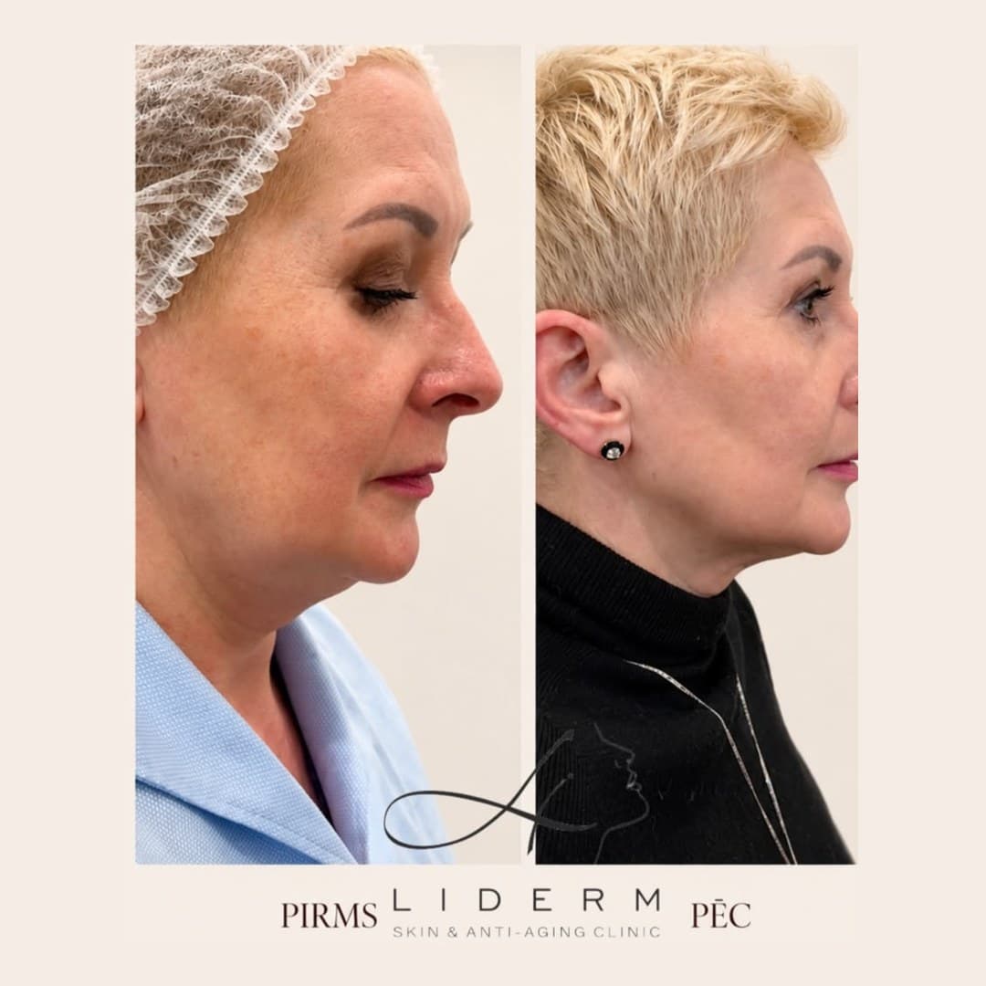 Результат — до и после в клинике LIDERM