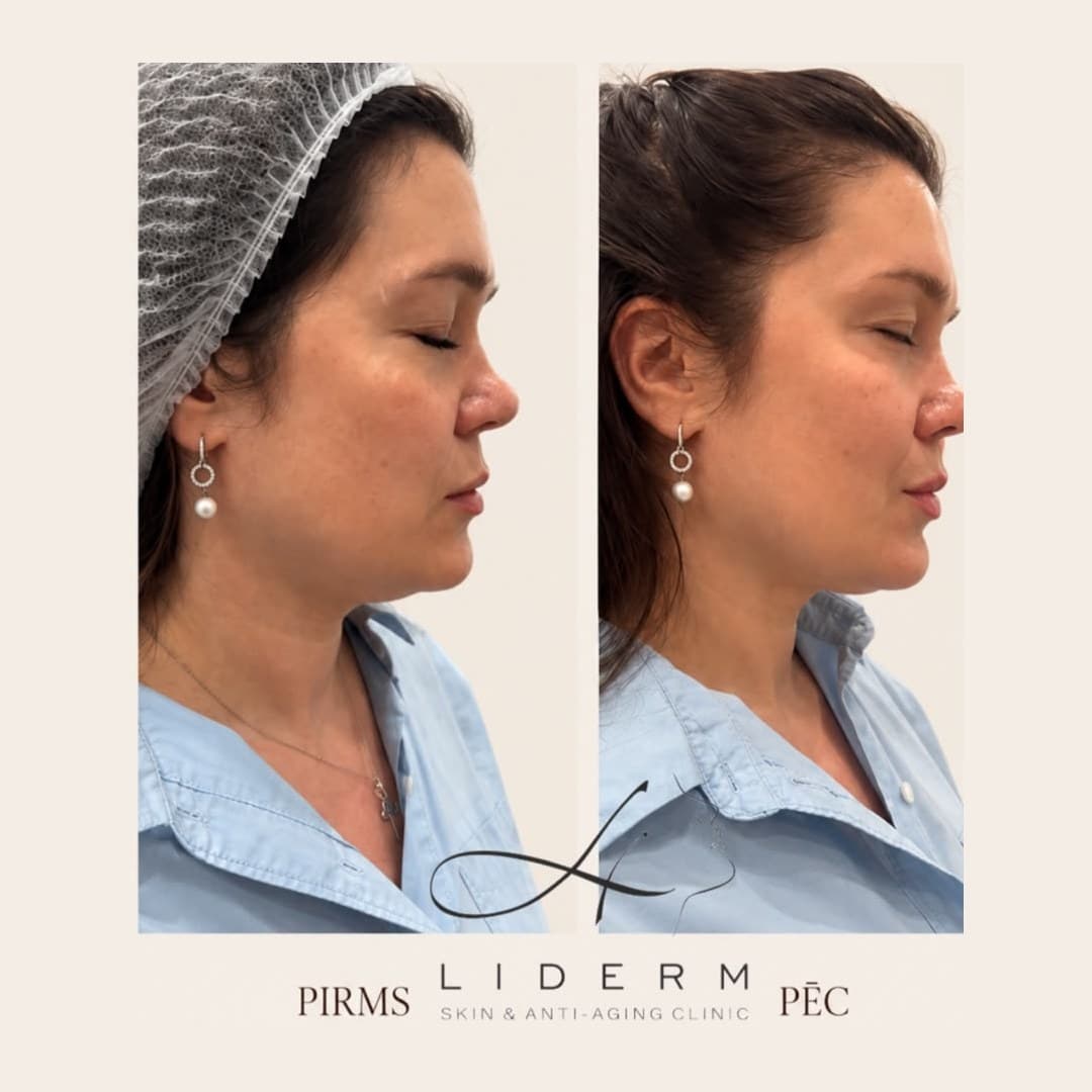 Результат — до и после в клинике LIDERM