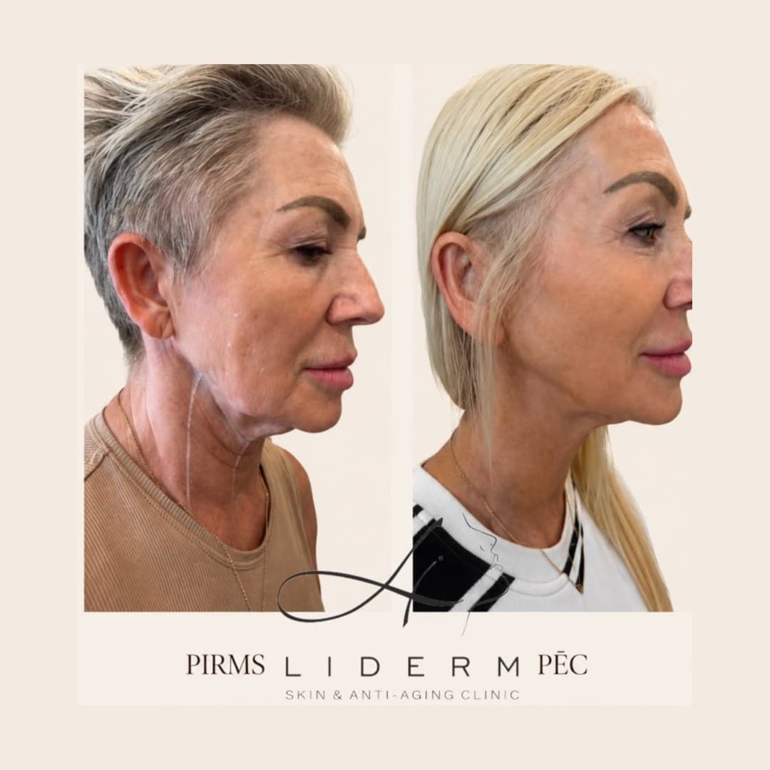 Результат — до и после в клинике LIDERM