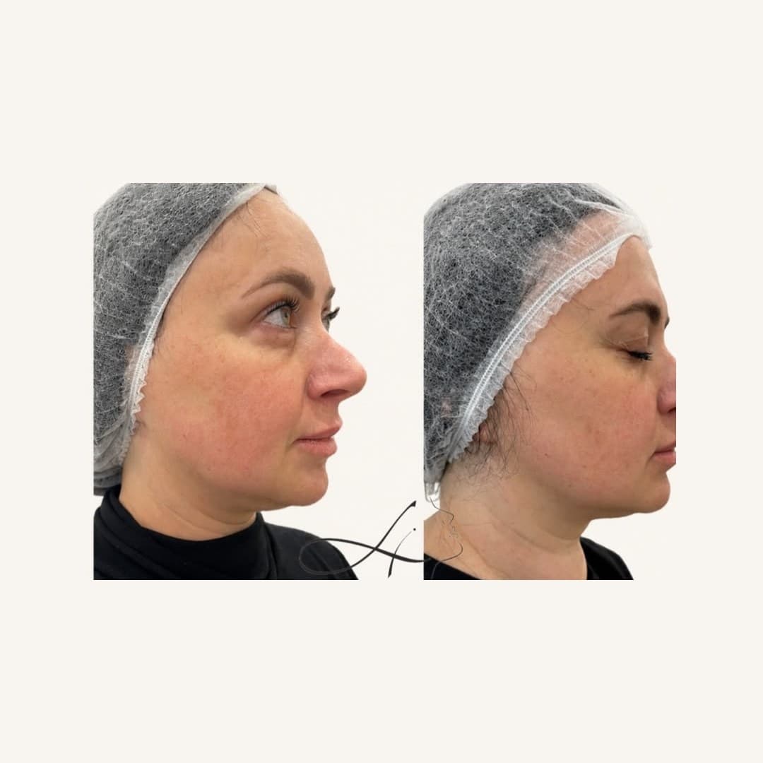 Результат — до и после в клинике LIDERM