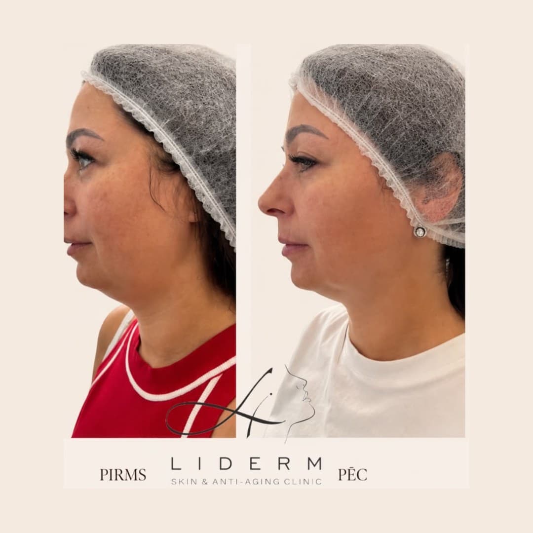 Результат — до и после в клинике LIDERM