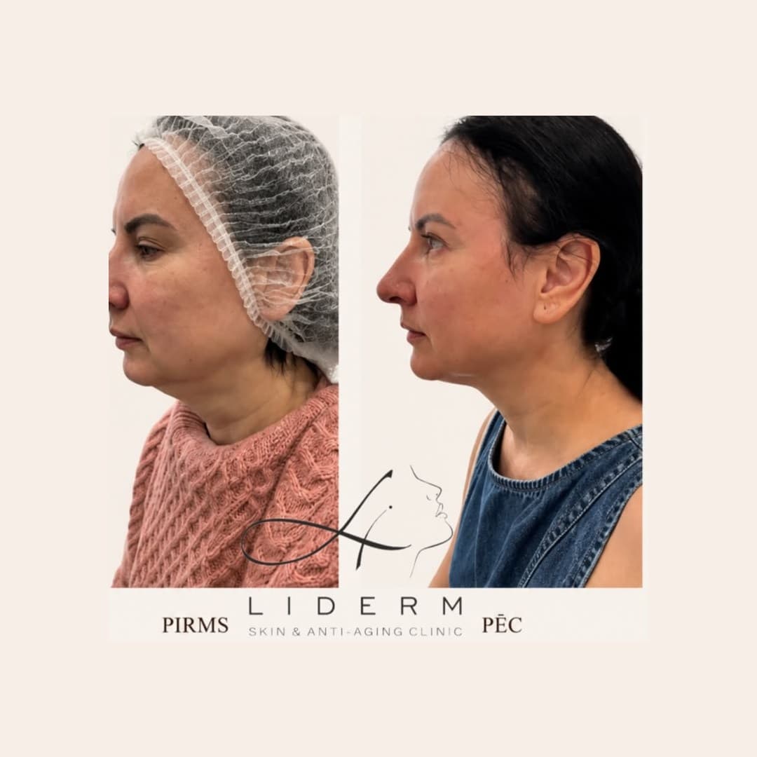 Результат — до и после в клинике LIDERM