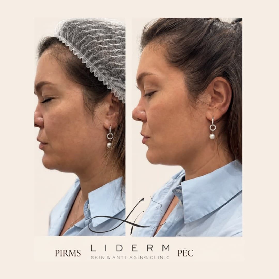 Результат — до и после в клинике LIDERM