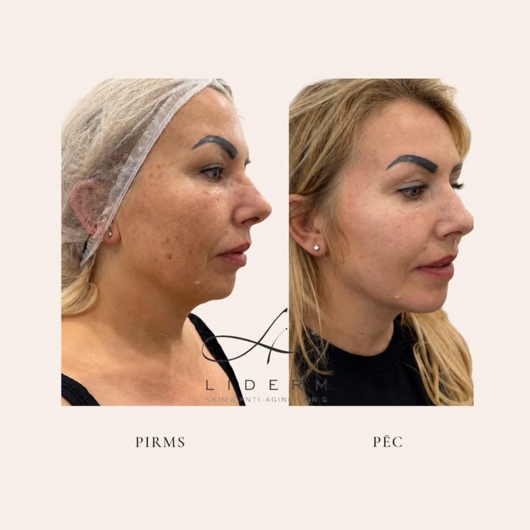 Результат — до и после в клинике LIDERM