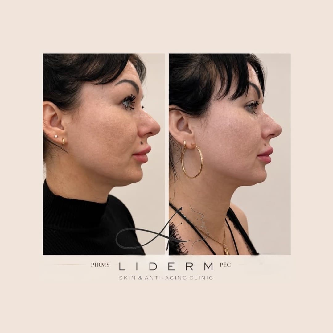Результат — до и после в клинике LIDERM