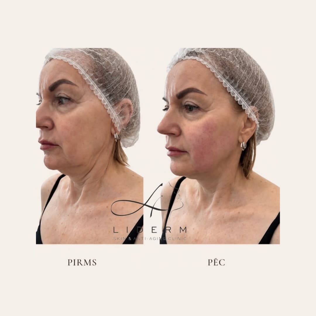 Результат — до и после в клинике LIDERM