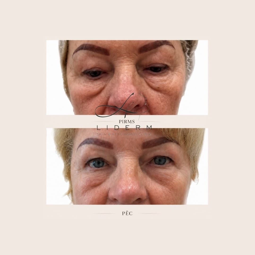 Результат — до и после в клинике LIDERM