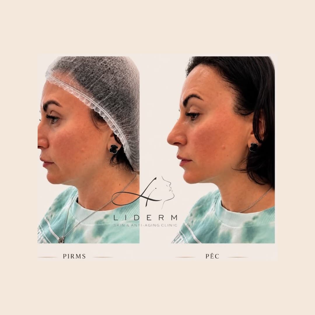 Результат — до и после в клинике LIDERM