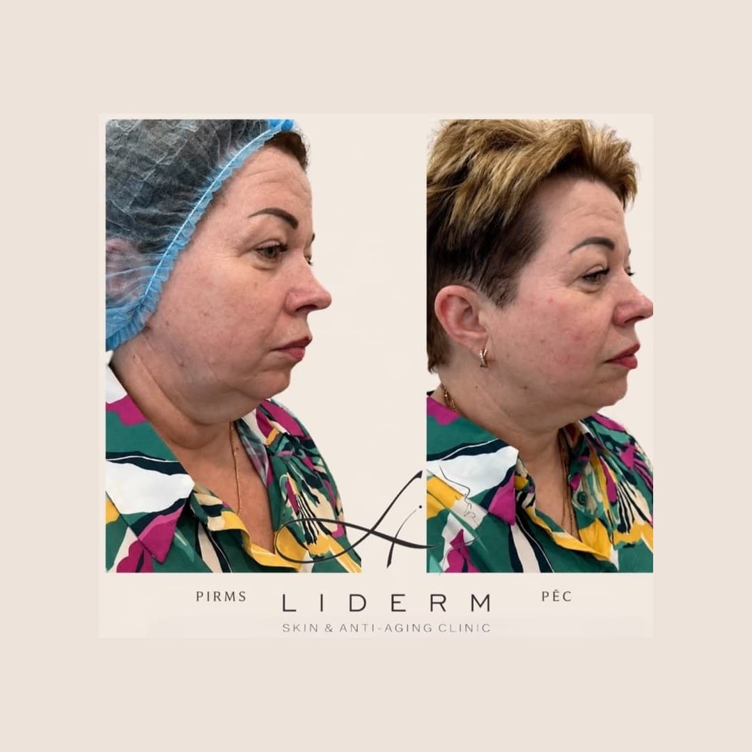 Результат — до и после в клинике LIDERM