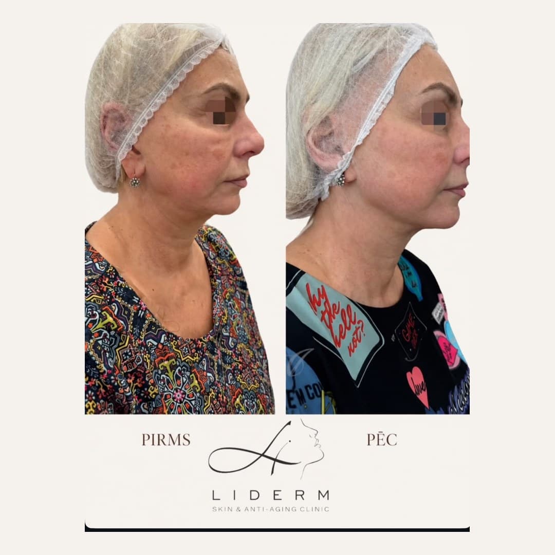 Результат — до и после в клинике LIDERM