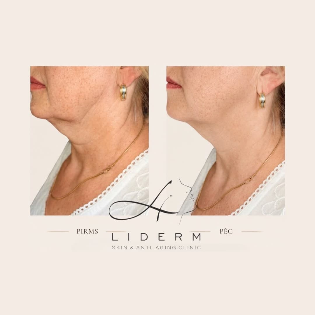 Результат — до и после в клинике LIDERM