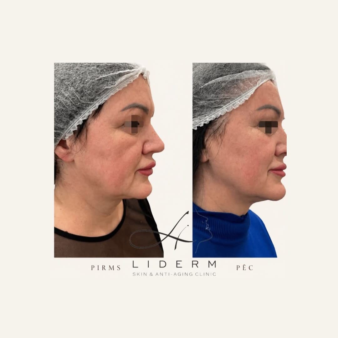 Результат — до и после в клинике LIDERM
